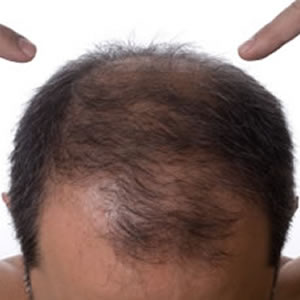 cure for baldness